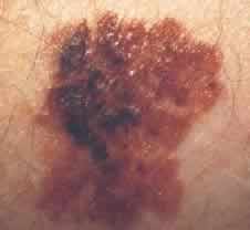 melanoma